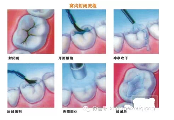 口腔窩溝封閉，就如同給牙齒穿上了一層保護(hù)衣，使牙齒免受食物侵蝕。原理：窩溝封閉后，窩溝內(nèi)原有的細(xì)菌斷。