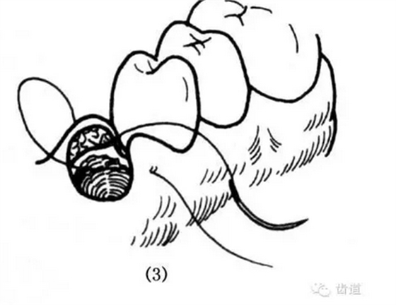 牙醫(yī)基本技能：口內(nèi)縫合術(shù)（文字、示意圖及視頻）