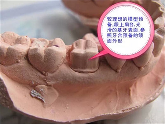 備牙應(yīng)注意的事項(xiàng)+備牙取摸損傷牙齦問題
