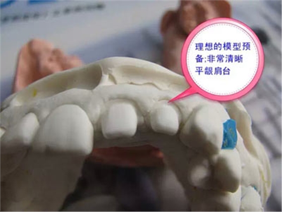 備牙應(yīng)注意的事項(xiàng)+備牙取摸損傷牙齦問題