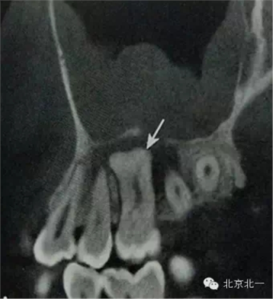 種植遇到骨島怎么辦