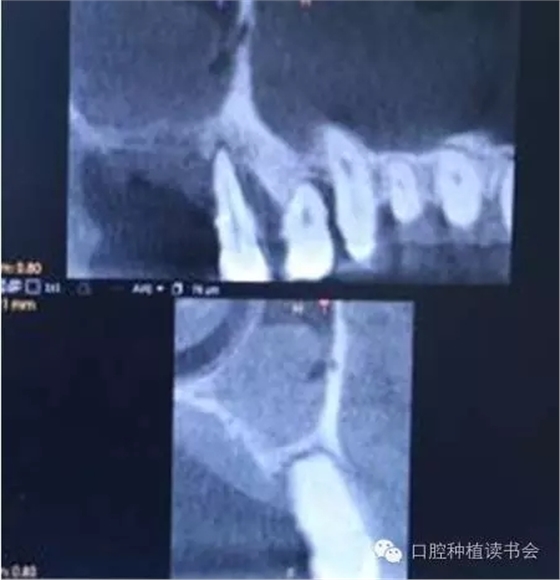 上頜后牙區(qū)種植治療的關(guān)鍵技術(shù)之—上頜竇提升術(shù)