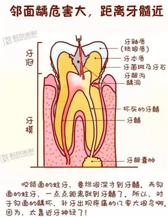 牙縫間的黑線是鄰面齲，還一壞壞倆，巧用它幫你渡過一“劫”