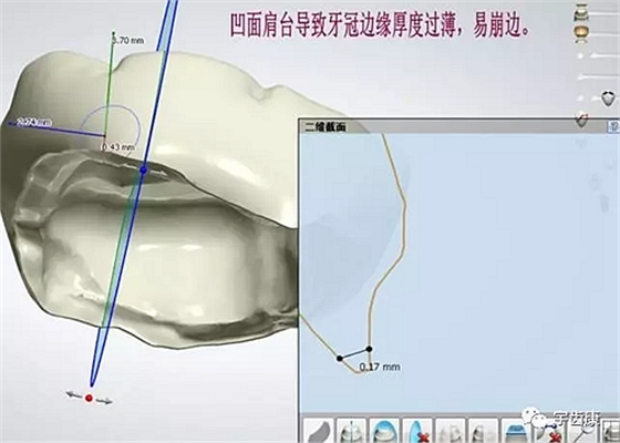 影響全瓷牙冠裂的因素有哪些？
