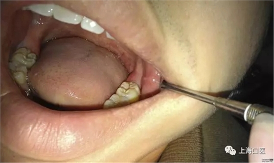 拔牙干槽癥可怕嗎？