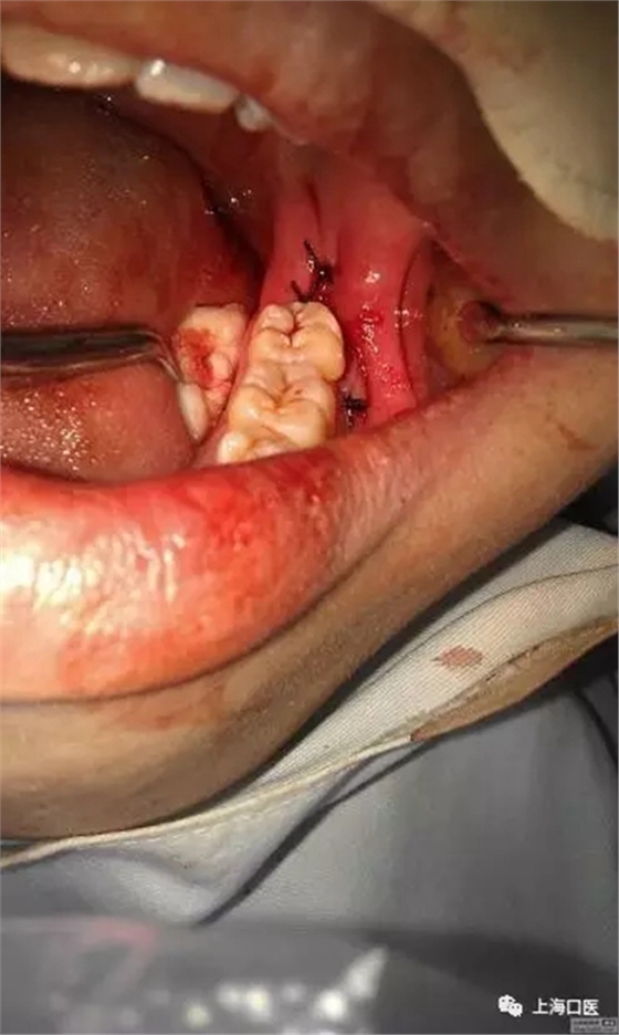 拔牙干槽癥可怕嗎？