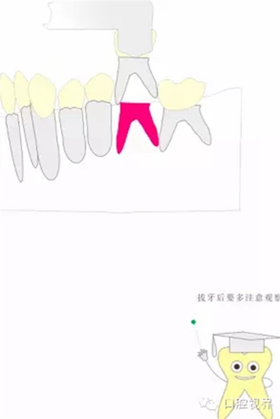 【愛牙科普知識(shí)300問】 “什么是活髓切斷術(shù)？”