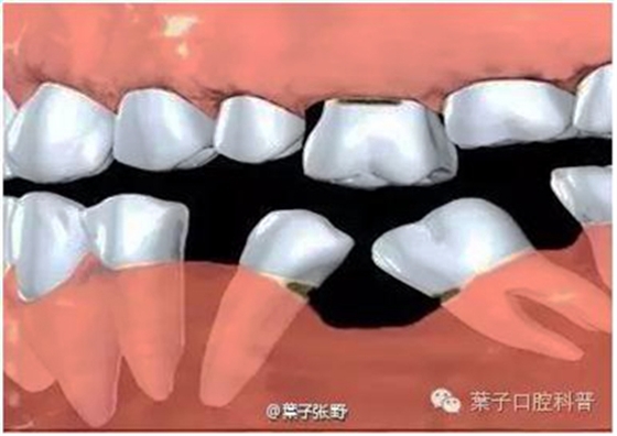 乳牙缺失致恒牙“亂長”，這個“間隙保持器”可預防