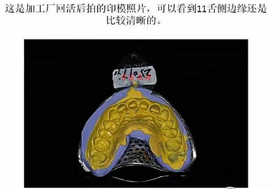 前牙外傷冠延長+全瓷冠修復(fù)