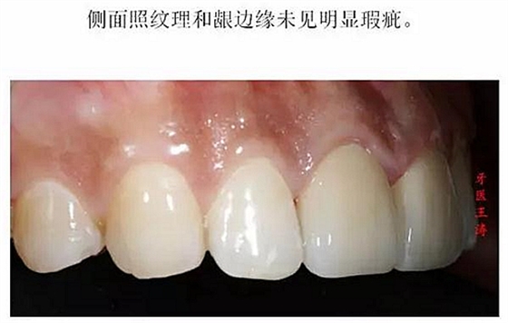 前牙外傷冠延長+全瓷冠修復(fù)
