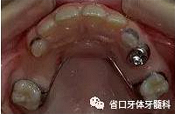 【牙醫(yī)學(xué)堂】間隙保持器的介紹  