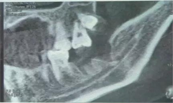 拔牙斷根的去與留？