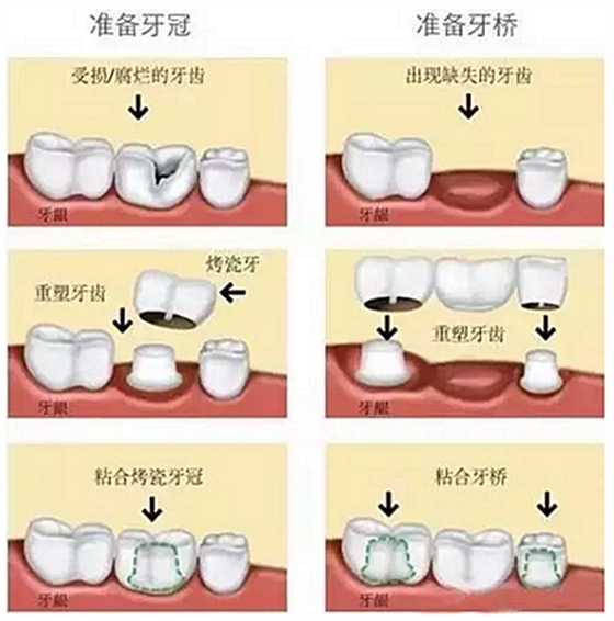 一位資深牙醫(yī)的總結(jié) | 如何減輕患者鑲牙后酸痛癥狀的措施！