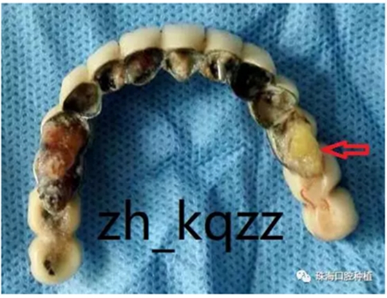 固定假牙（烤瓷牙）的致命缺點