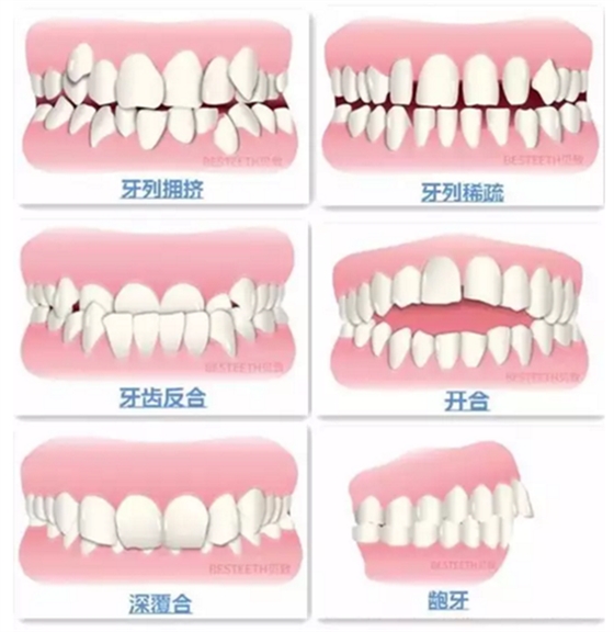 【口腔科普】關(guān)于矯牙前、中、后需要注意的問(wèn)題，了解一下？