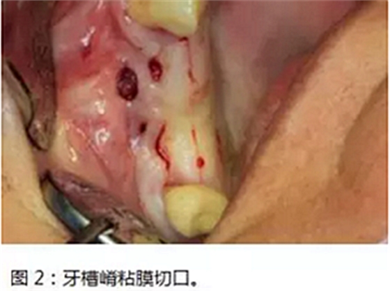 上頜竇瘺修補術——改良式旋轉(zhuǎn)帶蒂粘膜瓣修補術的應用