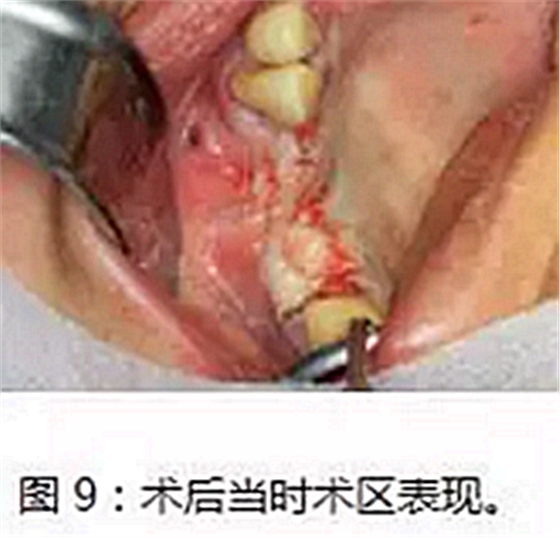 上頜竇瘺修補術——改良式旋轉(zhuǎn)帶蒂粘膜瓣修補術的應用