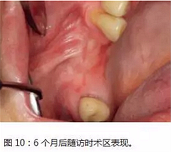 上頜竇瘺修補術——改良式旋轉(zhuǎn)帶蒂粘膜瓣修補術的應用