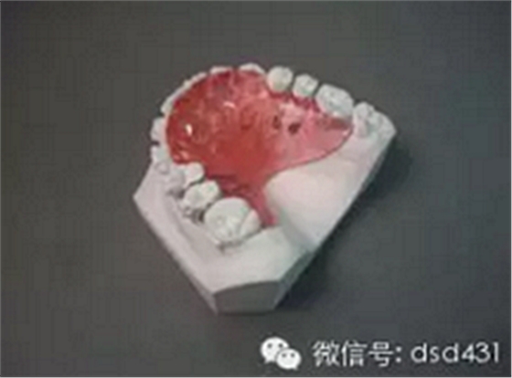 是什么導(dǎo)致了義齒返工？？？