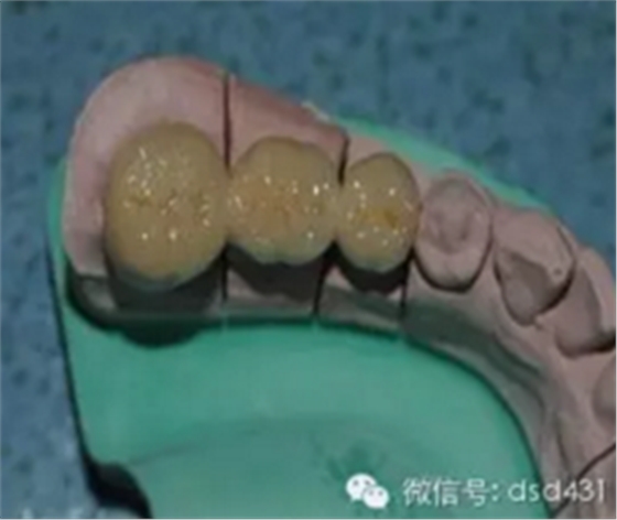 是什么導(dǎo)致了義齒返工？？？