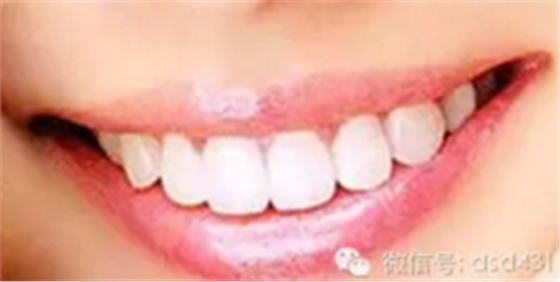是什么導(dǎo)致了義齒返工？？？
