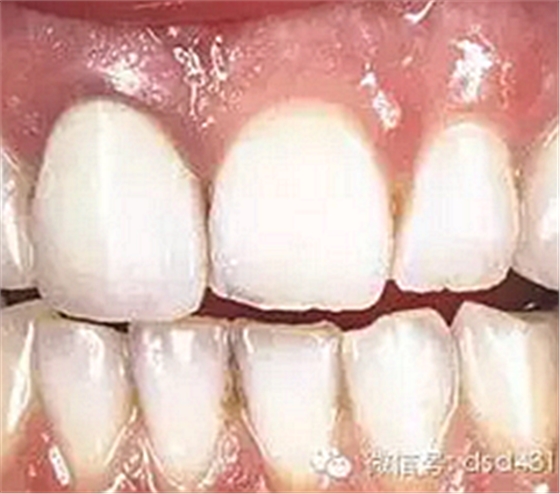 是什么導(dǎo)致了義齒返工？