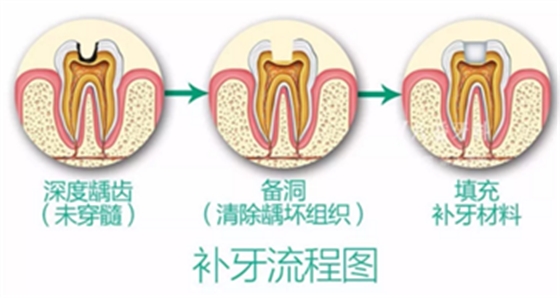 完全不懂，各種補(bǔ)牙材料，到底怎么選？
