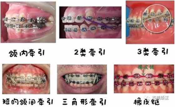 牙齒矯正，為什么要掛橡皮筋？