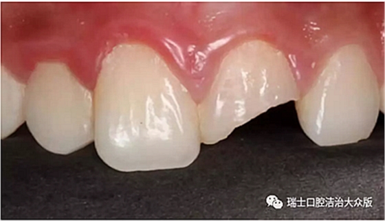 成人牙齒外傷了怎么應(yīng)急處理？