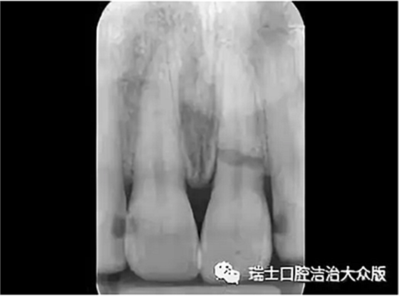 成人牙齒外傷了怎么應(yīng)急處理？