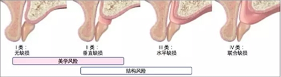 【文獻精讀】唇-齒-牙槽嵴分類：無牙頜上頜牙弓指南。診斷，風險評估及種植治療指征