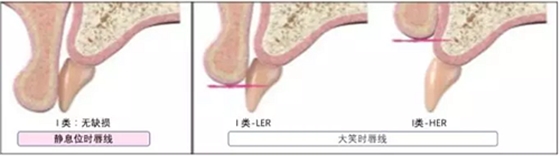 【文獻精讀】唇-齒-牙槽嵴分類：無牙頜上頜牙弓指南。診斷，風險評估及種植治療指征