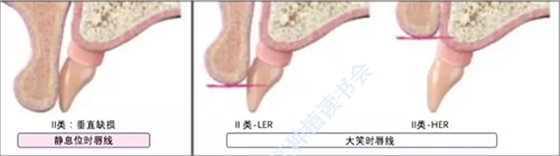 【文獻精讀】唇-齒-牙槽嵴分類：無牙頜上頜牙弓指南。診斷，風險評估及種植治療指征
