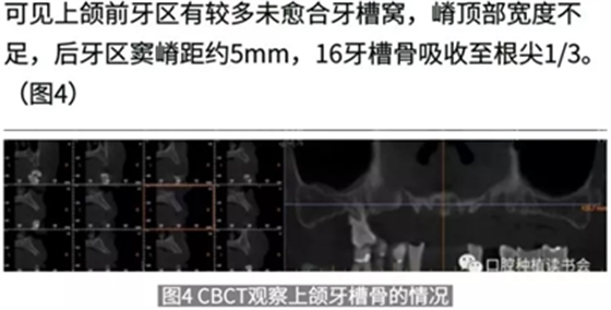 病例報(bào)道│全程數(shù)字化輔助無牙頜種植即刻負(fù)重