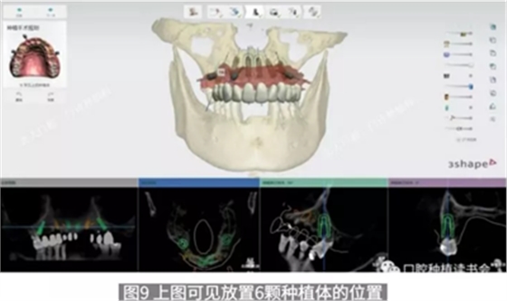 病例報(bào)道│全程數(shù)字化輔助無牙頜種植即刻負(fù)重