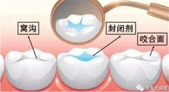 兒童防齲齒【窩溝封閉】和【涂氟】是一回事兒嗎？