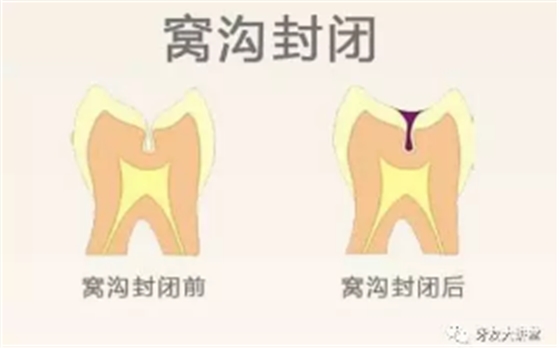 兒童防齲齒【窩溝封閉】和【涂氟】是一回事兒嗎？