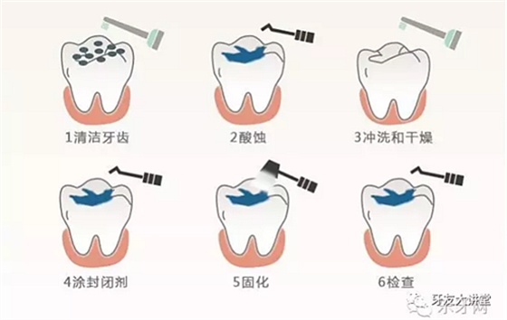兒童防齲齒【窩溝封閉】和【涂氟】是一回事兒嗎？