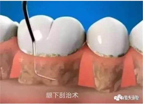 牙周炎，中國(guó)成年人后半生永遠(yuǎn)的 痛 ！