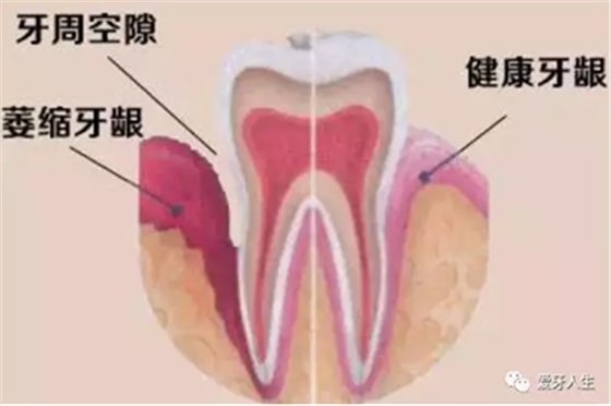 牙齦萎縮怎么辦？