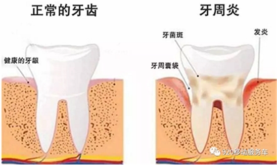 牙齦萎縮怎么辦？