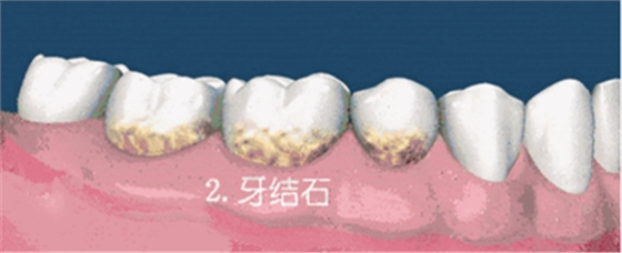 牙齦萎縮怎么辦？