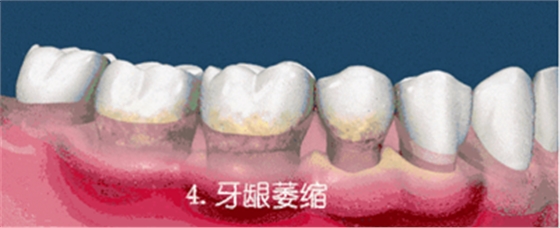 牙齦萎縮怎么辦？