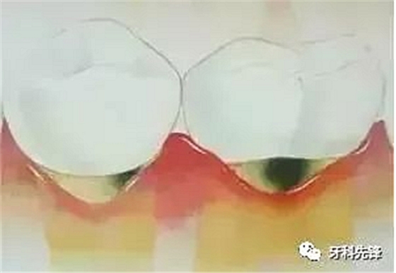 	牙齦萎縮是不治之癥？緩解牙齦萎縮5步走！