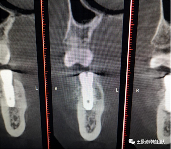 后牙區(qū)即刻種植的適應癥的思考