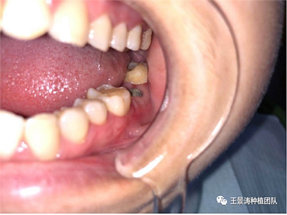 后牙區(qū)即刻種植的適應癥的思考