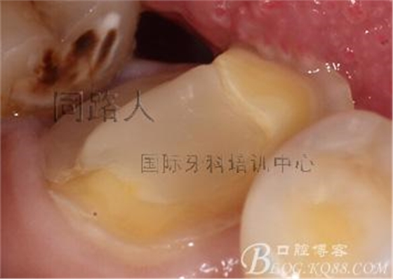 樹脂嵌體制作的階段性總結(jié)