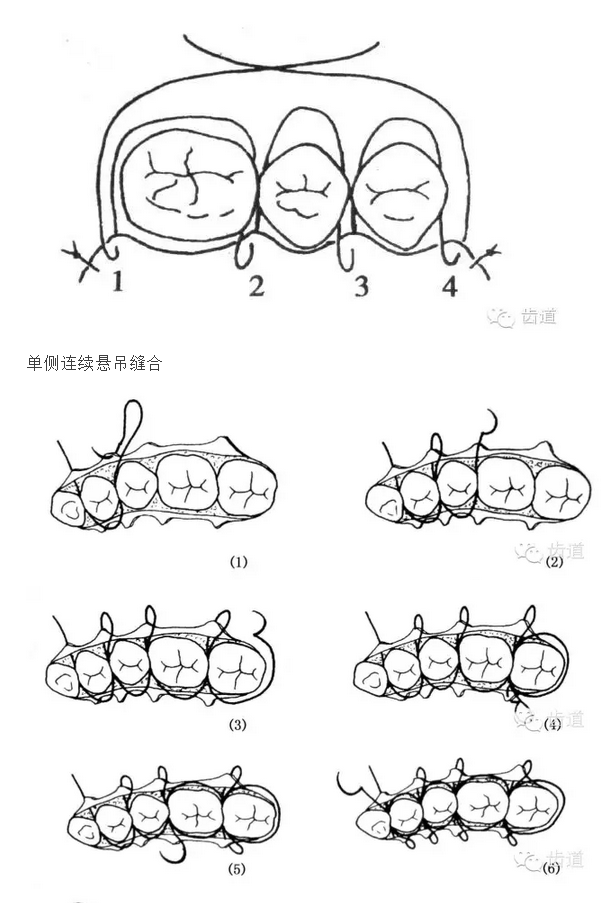 牙醫(yī)基本技能：口內(nèi)縫合術(shù)（文字、示意圖及視頻）