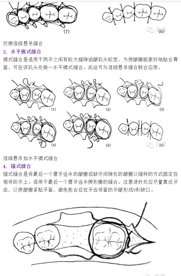 牙醫(yī)基本技能：口內(nèi)縫合術(shù)（文字、示意圖及視頻）