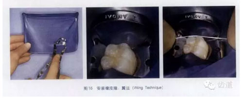 橡皮障的臨床運(yùn)用大全 橡皮障的臨床運(yùn)用大全